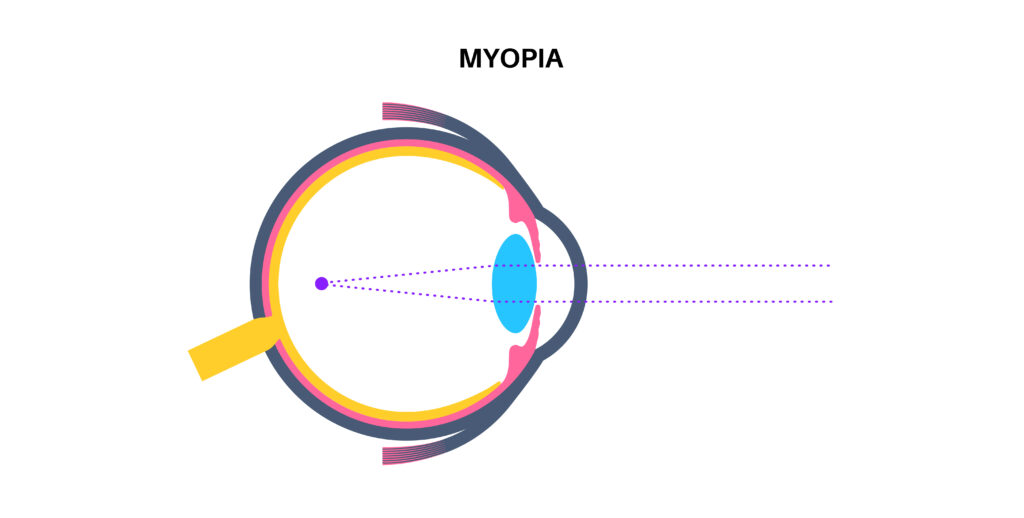 Myopia